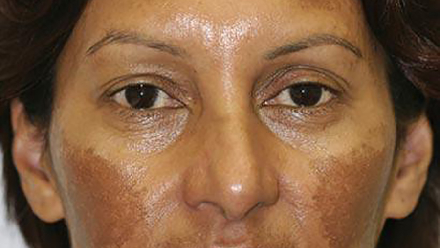 Successful Treatment Of Ota Nevus With The 532 Nm Solid State Picosecond Laser Mdedge Dermatology