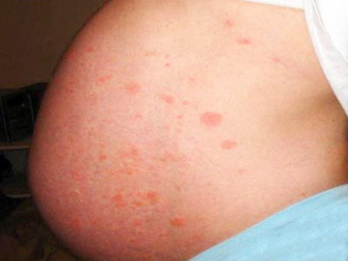 is herpes zoster safe during pregnancy